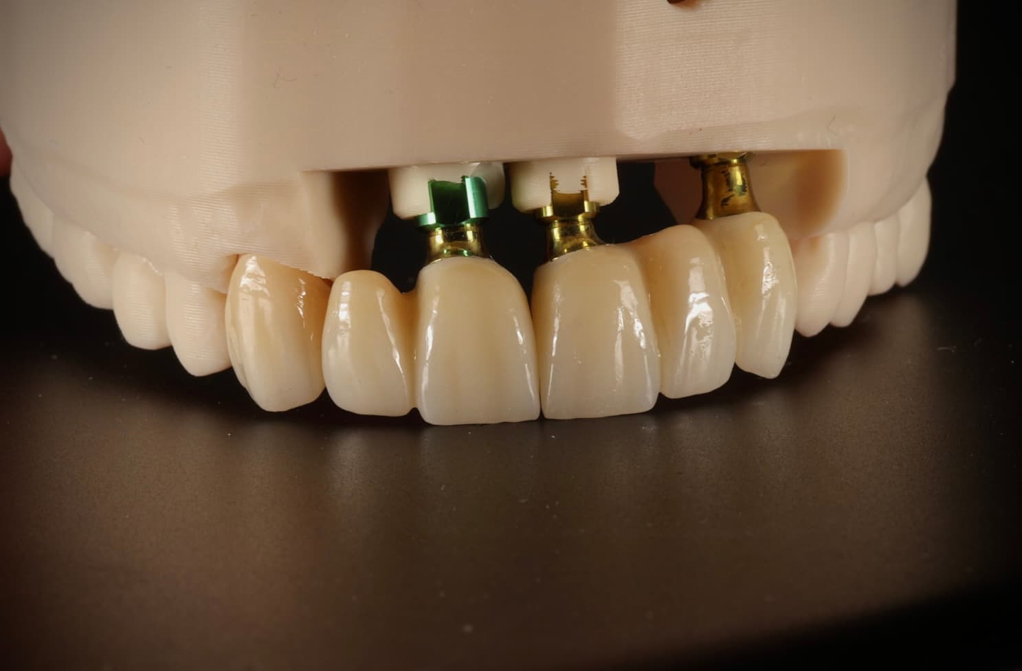 CUSTOMIZED ABUTMENTS