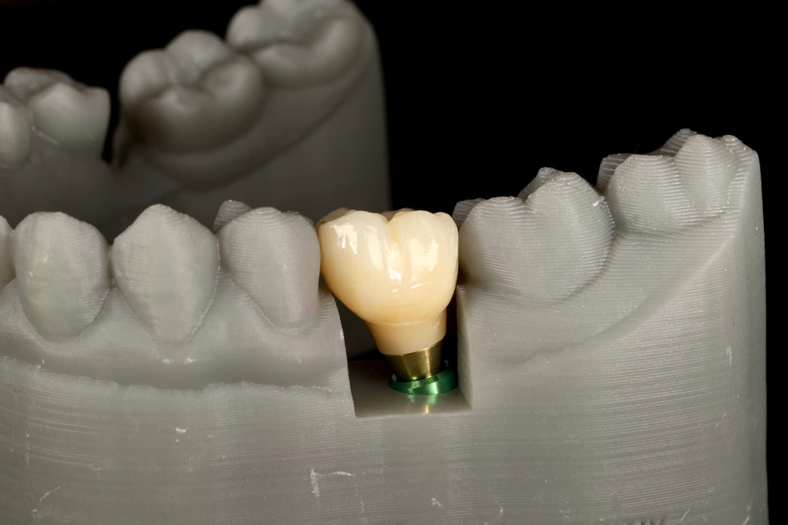 Dental Implant 2