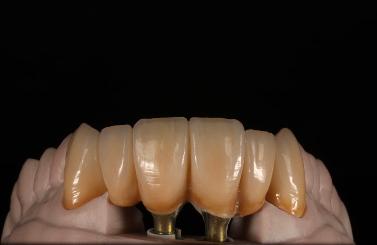 Dental Implant 10