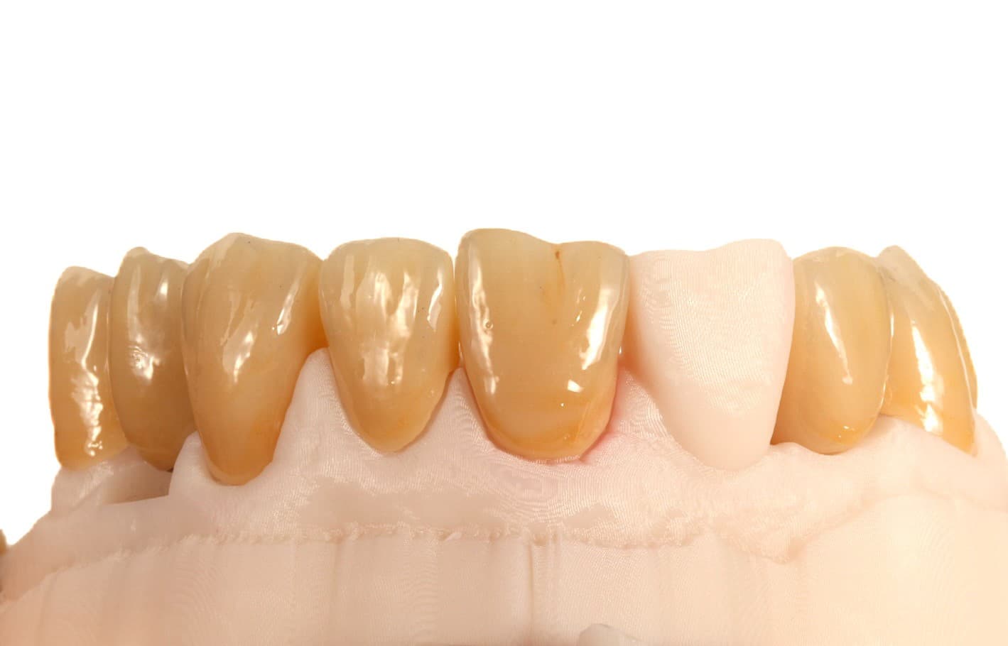 Dental implant procedure